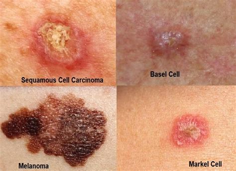 皮膚癌|Skin Cancer: Symptoms, Types & Treatment